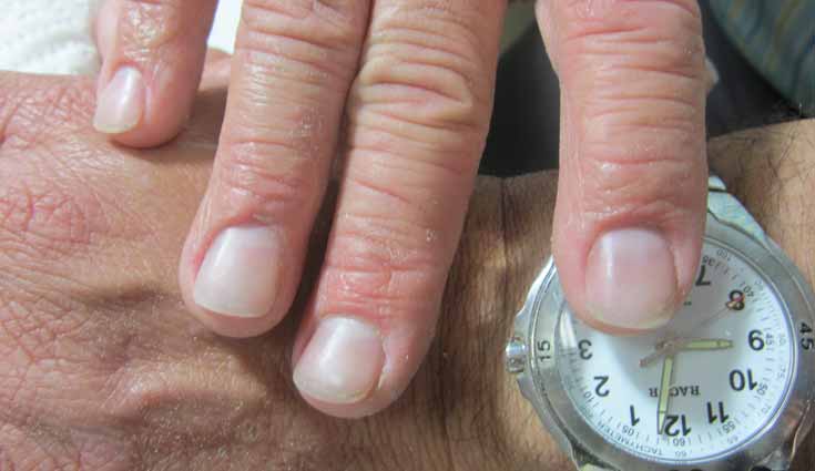 Uñas predicen si fumadores pueden desarrollar cáncer